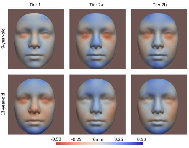 Frameword utilizado pelos cientistas para avaliar a exposição pré-natal ao álcool.
Da esquerda para a direita, as alterações faciais tornam-se mais pronunciadas, com vermelhos mais fortes (mostrando características que se afundam) e azuis mais fortes (mostrando características que se projetam mais).